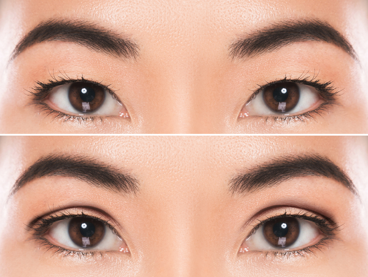 East asian outlet blepharoplasty