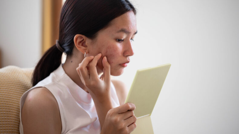 Treating Acne in Japan: A Savvy Guide
